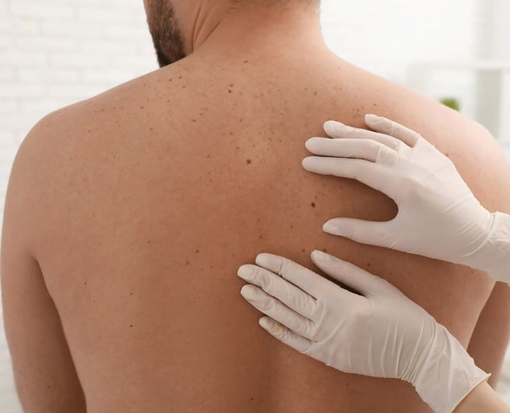 Skin Cancer Check